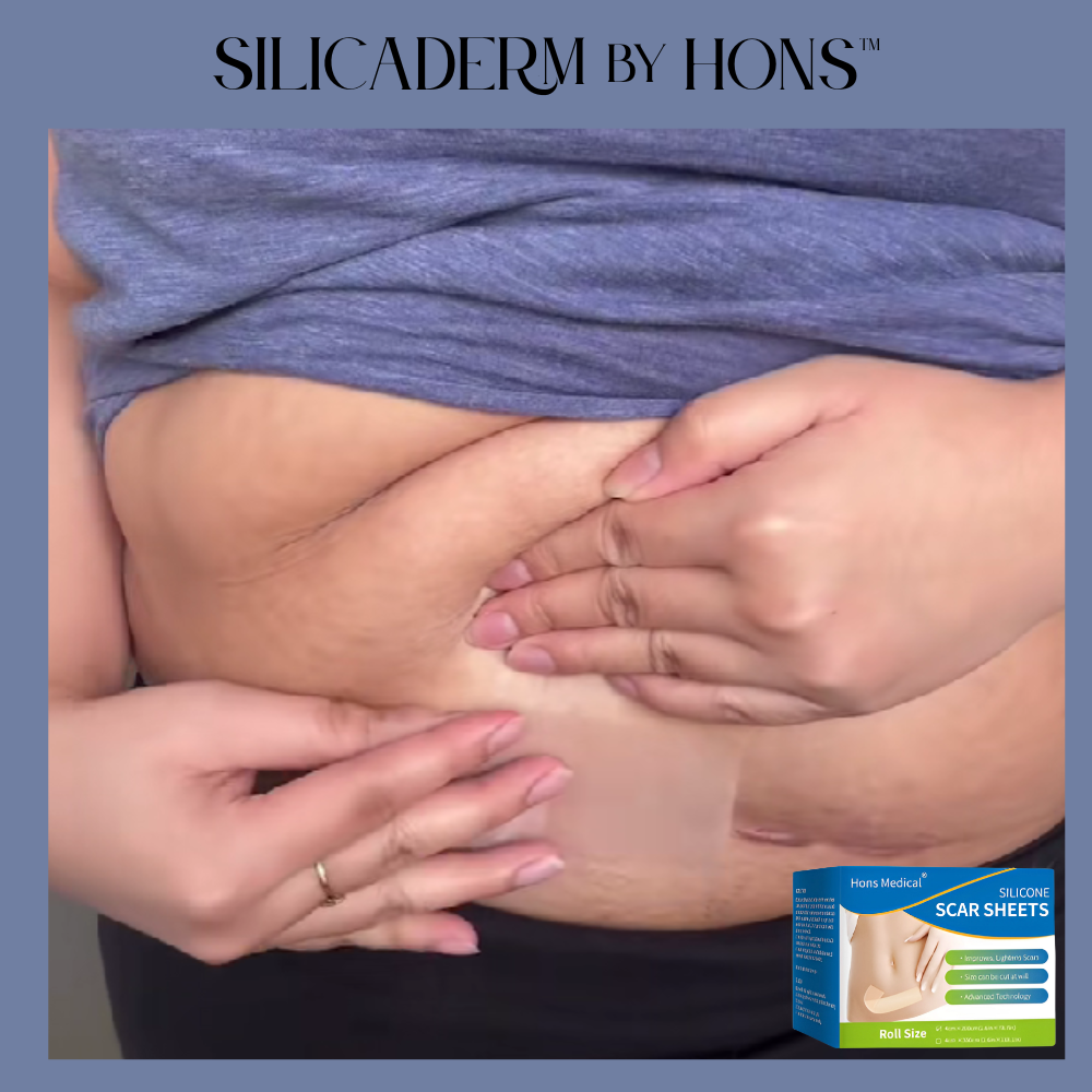 SilicaDerm by Hons™ Medical Silicone Scar Sheets